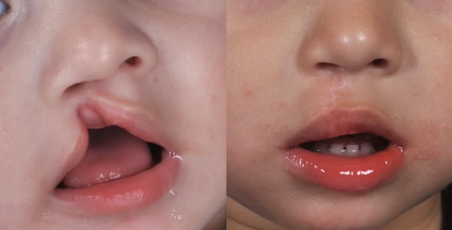 Infant receiving cleft and craniofacial care